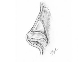 rinoplastia