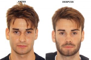 rinoplastia barcelona