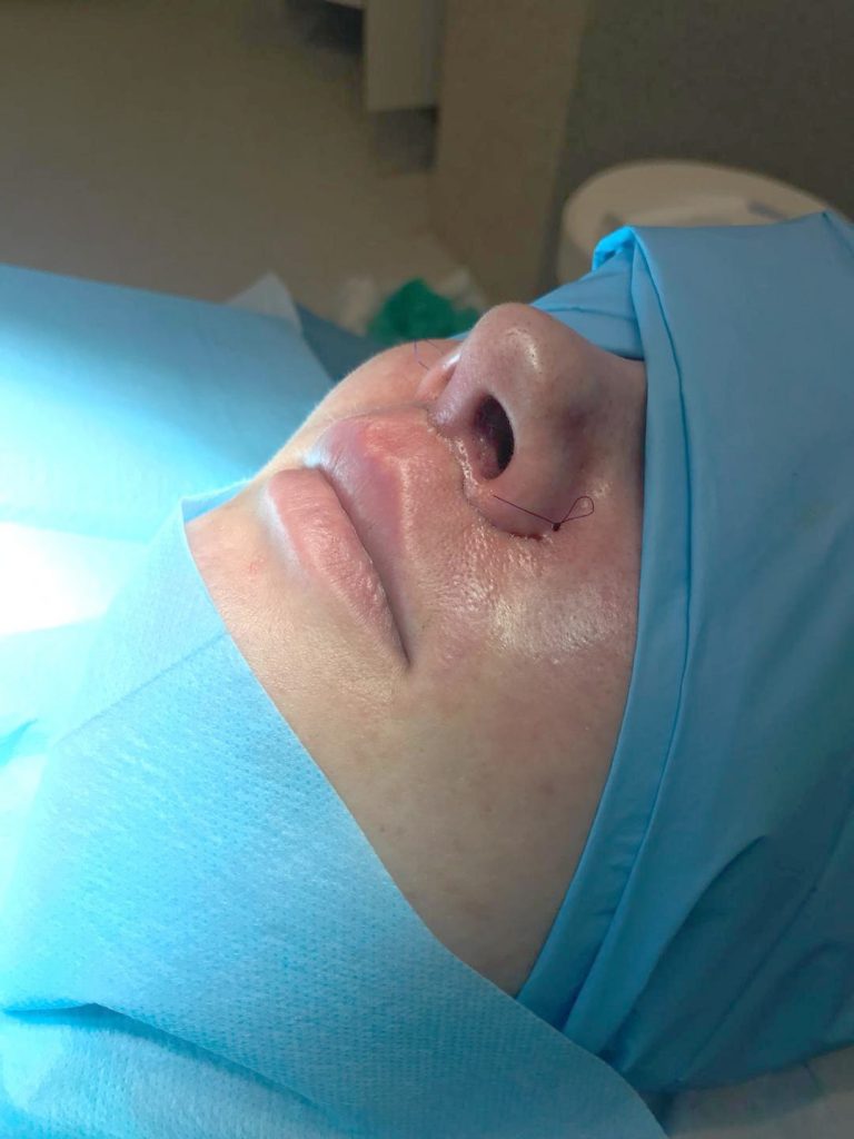rinoplastia barcelona