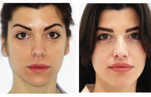 rinoplastia barcelona