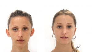 otoplastia antes y despues