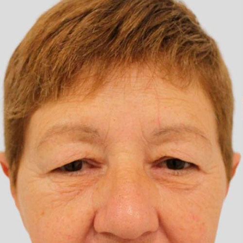 Surgery blepharoplasty before