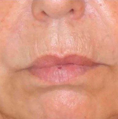 paciente antes de lip lift