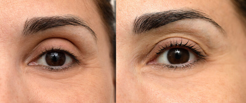 blefaroplastia superior antes y despues