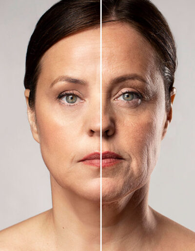 mini lifting facial antes y despues