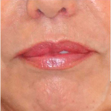 paciente despues de lip lift