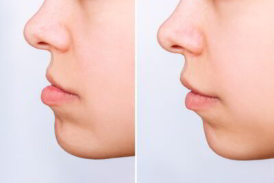 mentoplastia. antes y despues
