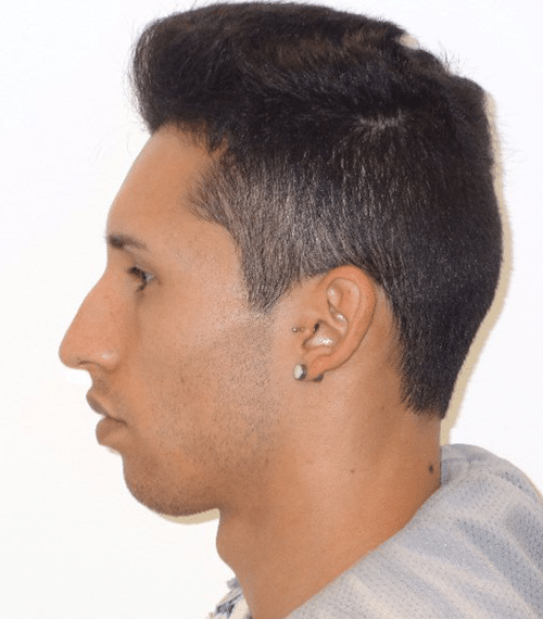 Antes