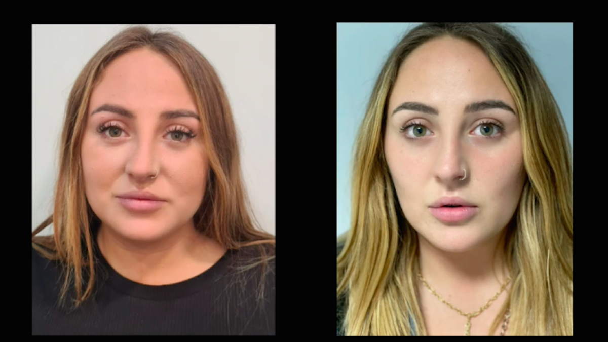 rocio flores antes y despues bichectomia