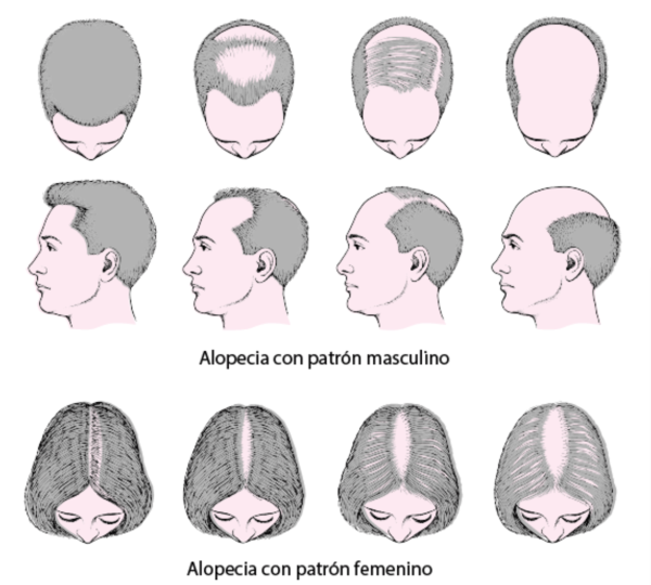 patrones de alopecia