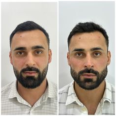 bichectomia hombre antes y despues