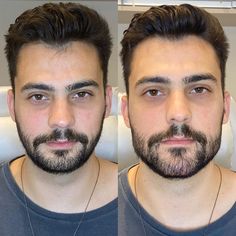 bichectomia masculina antes y despues