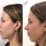 before-and-after- septorhinoplasty