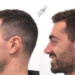 Ultrasonic Rhinoseptoplasty: Before and After