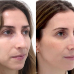 Rhinoseptoplasty before and after