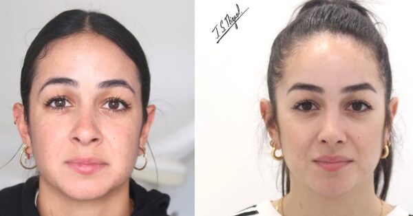 Paciente intervenida de Rinoplastia ultrasónica con preservación de dorso (push-down) y resección de bases alares.