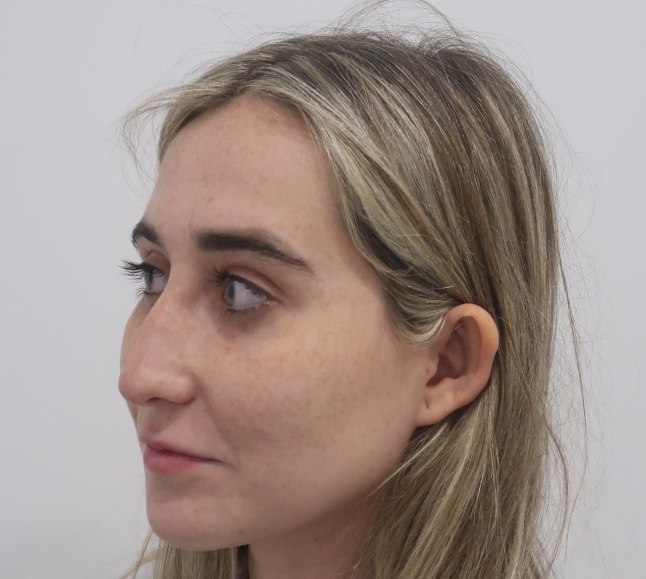 rinoplastia clara Tres quarts pre