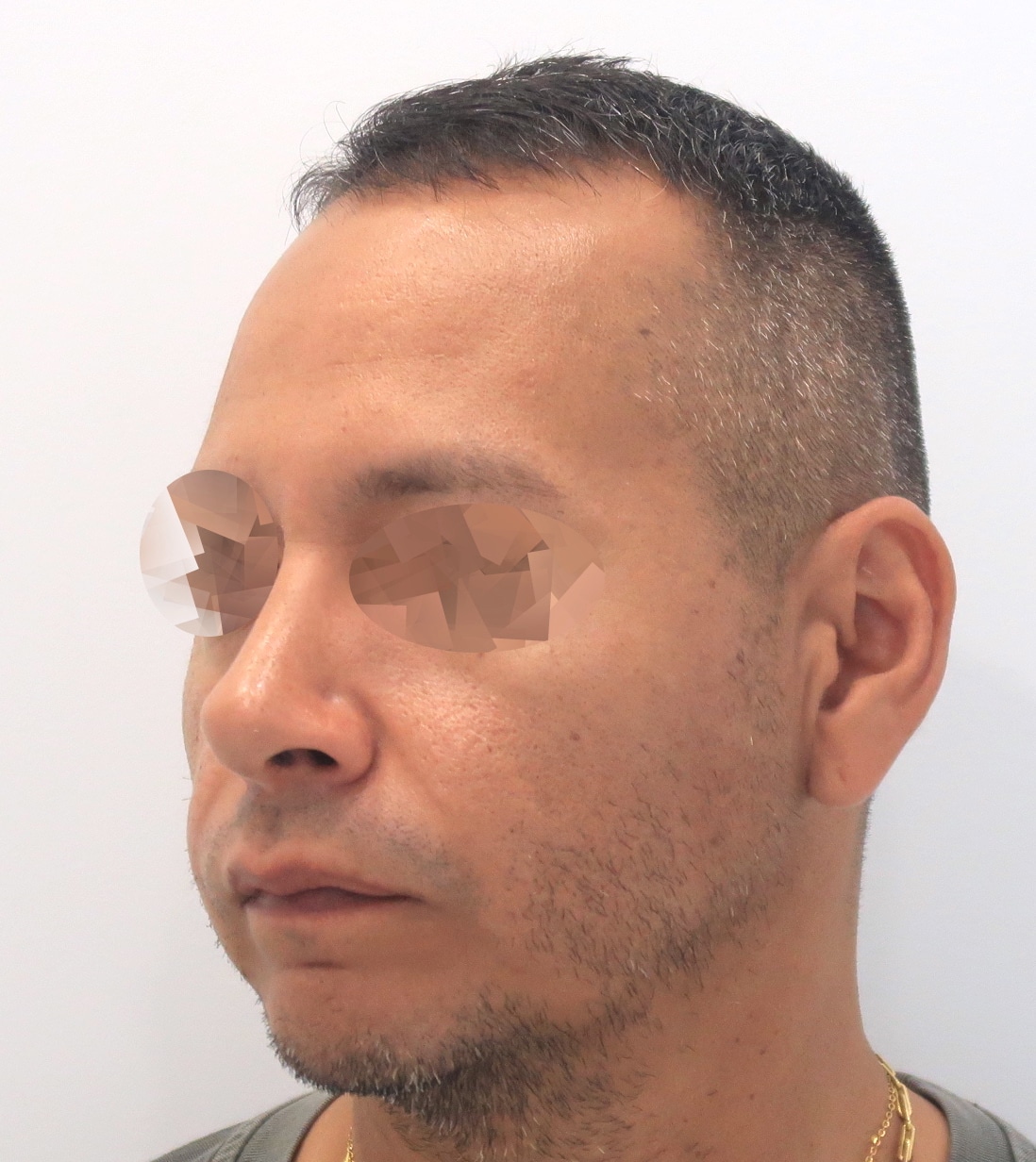 rinoplastia nicolas tres quarts post