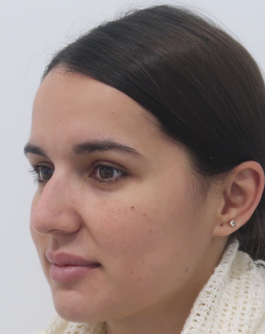 rinoplastia janet tres quarts pre