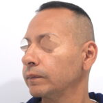 comunela caida antes rinoplastia