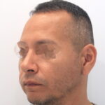 comunela caida despues rinoplastia
