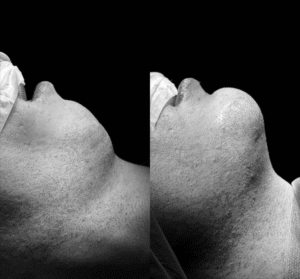 mentoplastia ultrasonica tras operacion