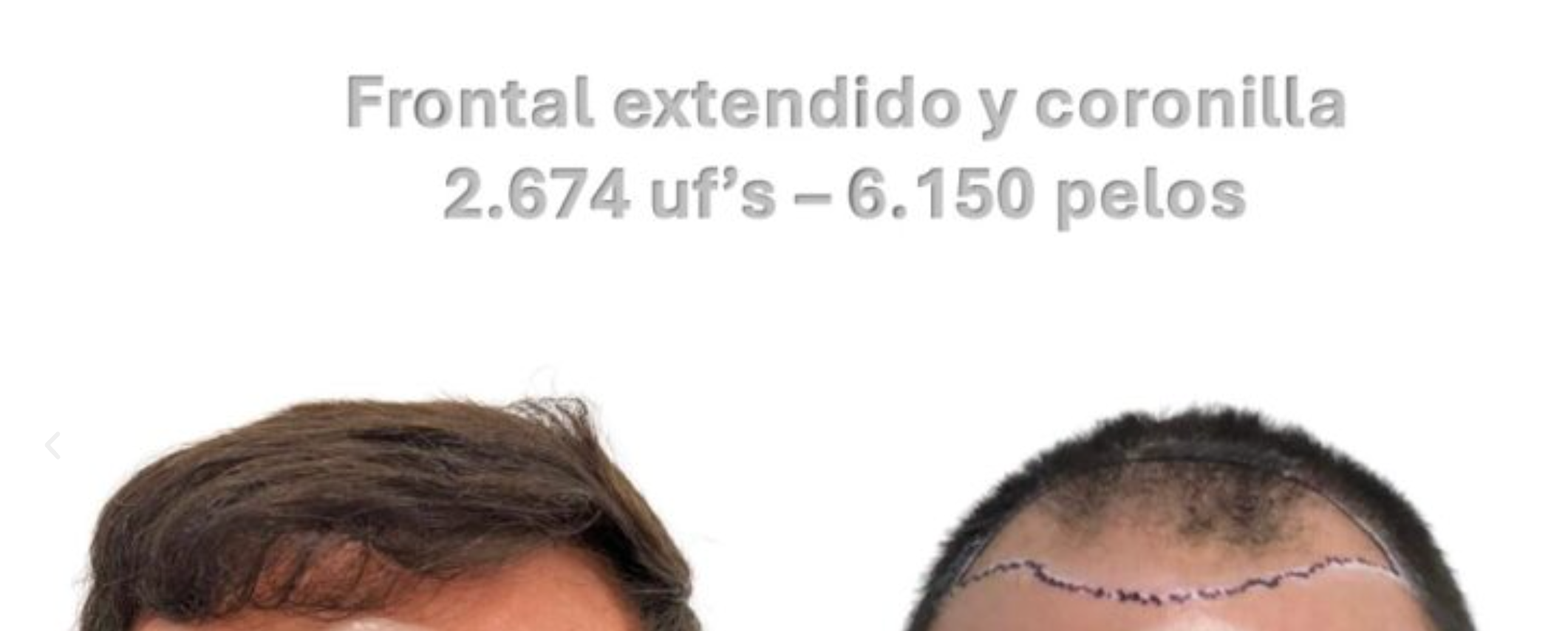 injerto capilar 6150 pelos- antes y despues