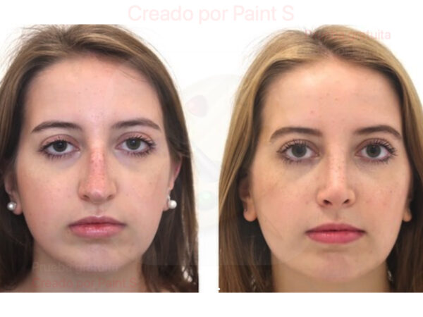 Paciente operada de rinoplastia en Pedralbes Clinic por Dr. San Miguel un mes después de la cirugía