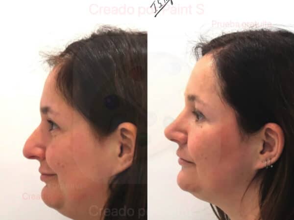 Rinoseptoplastia ultrasónica y Turbinoplastia con radiofrecuencia