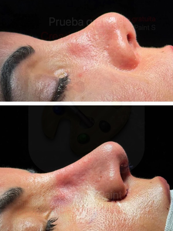 antes y despues de rinoplastia secundaria en quirofano