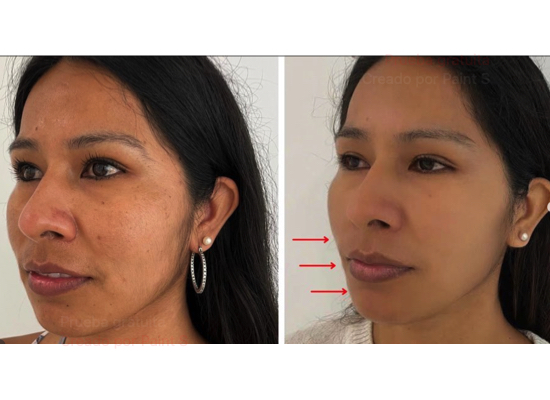 Resultado a los dos meses de Bichectomia. Dr. Coll