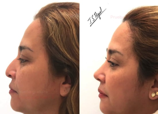 Rinoseptoplastia ultrasónica con injerto de extensión caudal