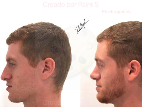 Paciente intervenido de Rinoseptoplastia ultrasónica y Turbinoplastia con radiofrecuencia.