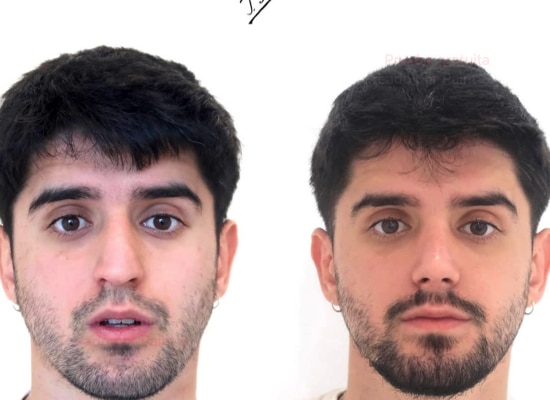 Rinoplastia ultrasónica masculina antes y despues