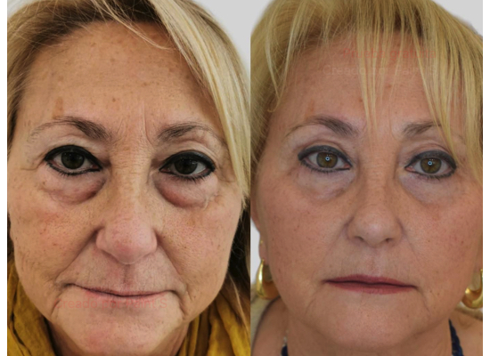 blefaroplastia completa antes y despues