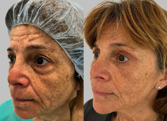 blefaroplastia inferior antes y despues