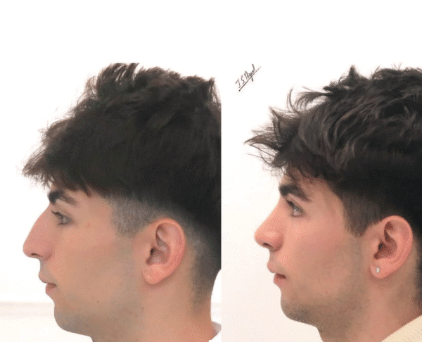 Rhinoseptoplasty and turbinoplasty patient: before and after