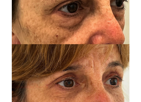 resultados blefaroplastia inferior