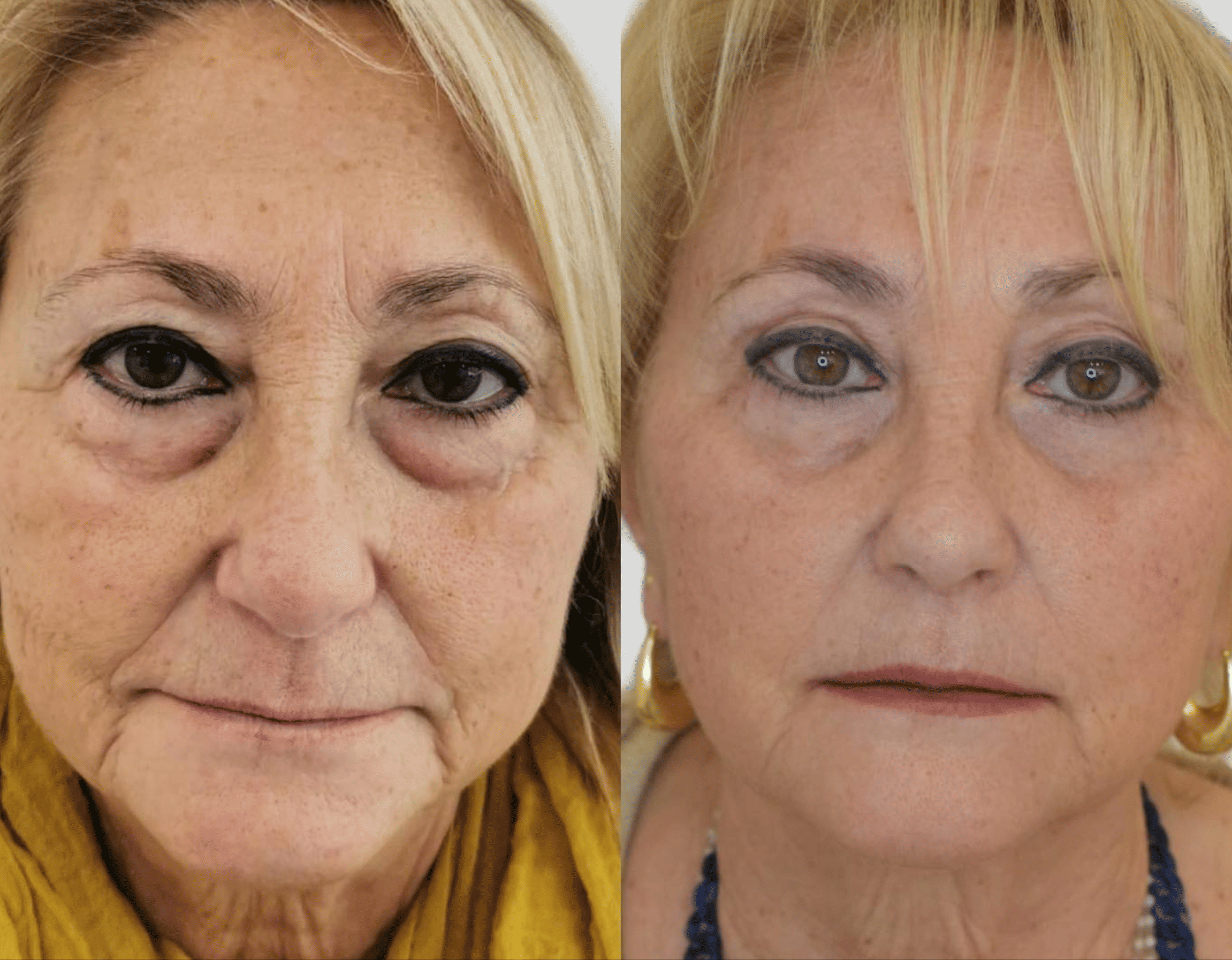 blefaroplastia completa. antes y despues