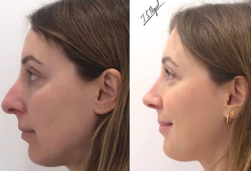 rinoseptoplastia ultrsaonica. antes y despues