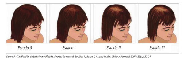 alopecia androgenica femenina