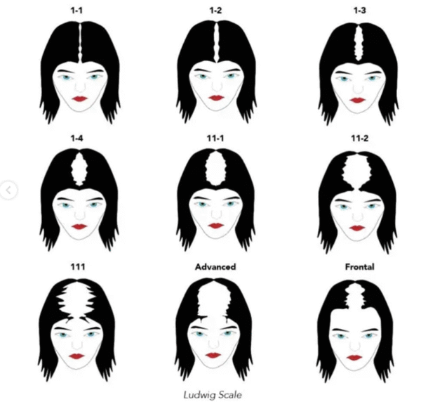 escala de ludwig. alopecia femenina
