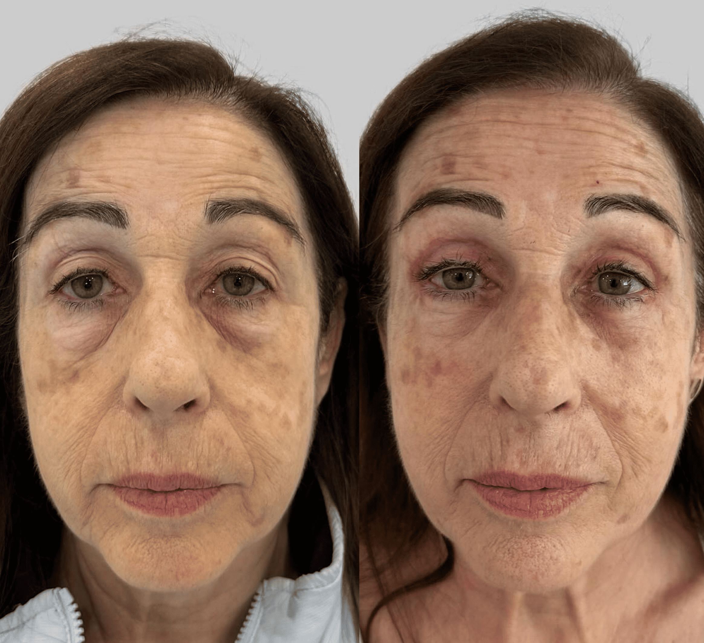 Befaroplastia completa. 4 parpados. Dr. Secondi. 2 meses despues