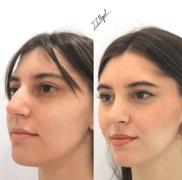 Paciente intervenida de Rinoplastia ultrasónica. 3 meses después