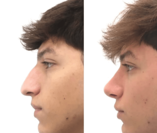 Paciente intervenido de Rinoseptoplastia ultrasónica. 8 meses después