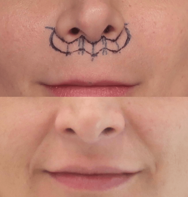 lip lift antes y despues de 6 meses