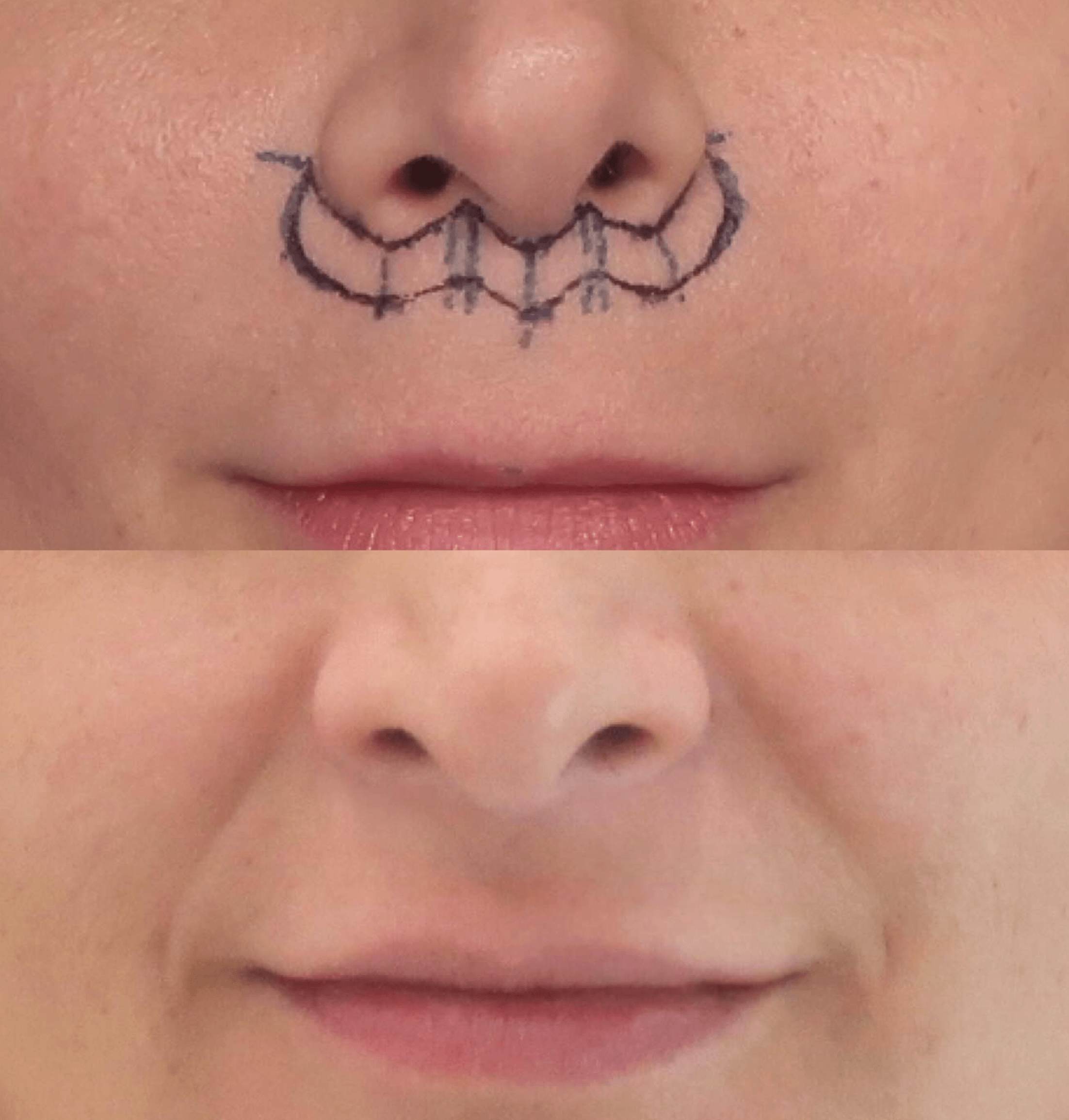 lip lift antes y despues de 6 meses