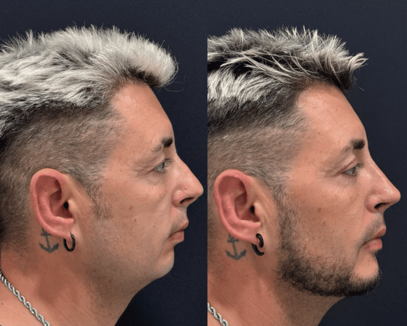 Blefaroplastia superior, una Rinoplastia ultrasónica y una Mentoplastia ultrasónica. 1 mes despues