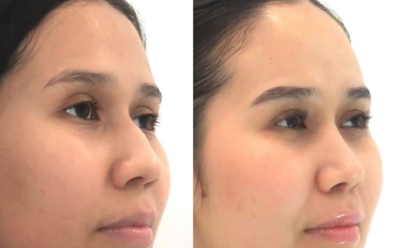 Rinoplastia , preservación de ligamentos y Septoplastia para injerto de extensión caudal