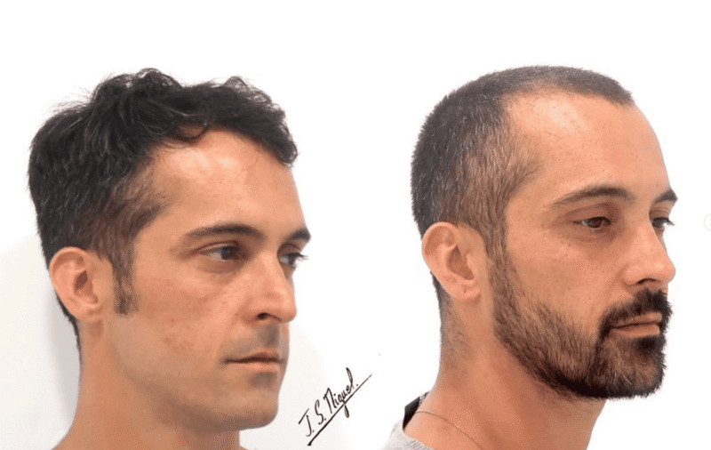 Rinoseptoplastia ultrasónica con preservación ligamentosa y Turbinoplastia